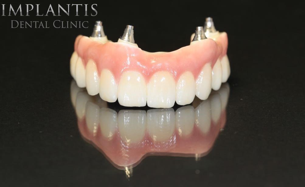 leczenie bezzębia implantami, all on 4, full arch, all on X