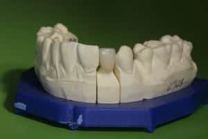 model zęba z założoną koroną porcelanową