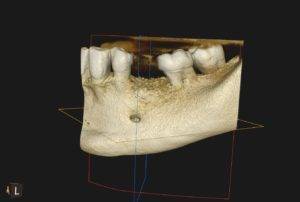 augmentacja przed implantami w Krakowie, dentysta Kraków