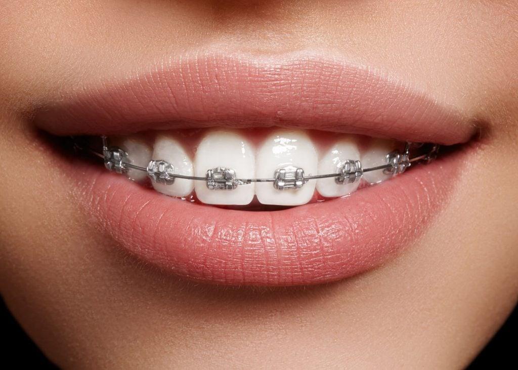 Aparat - ortodontyczny - staly - Implantis