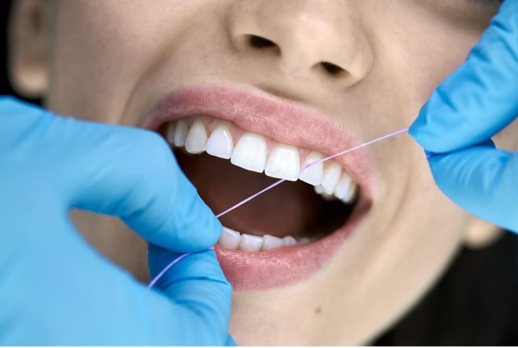 czyszczenie nitką dentystyczną przestrzeni między licówkami