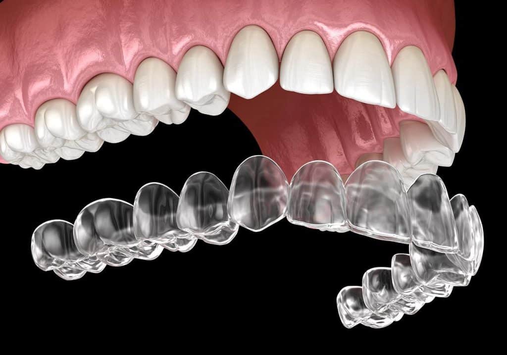 aligner Invisalign, aparat invisalign, leczenie invisalign, system invisalign