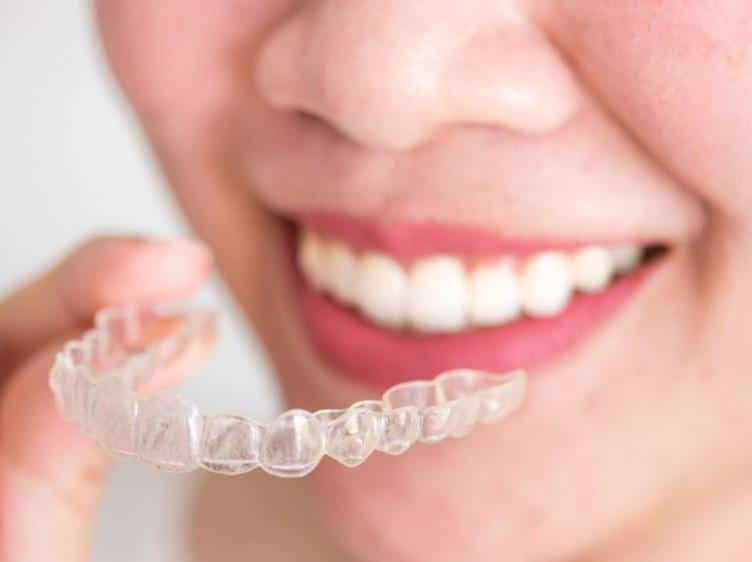 aparat Invisalign - zbliżenie