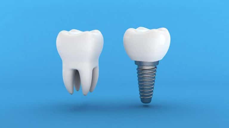 jak wygląda implant zęba 2022