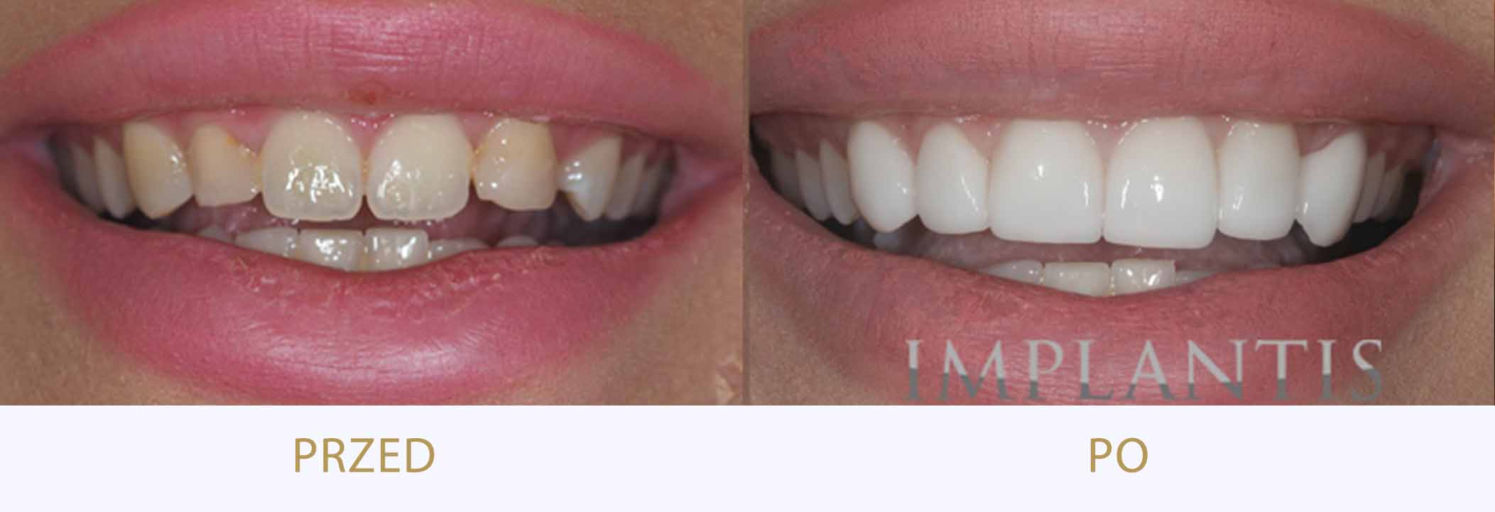 Efekty licówek porcelanowych – zdjęcie zębów przed i po zabiegu w Implantis Kraków