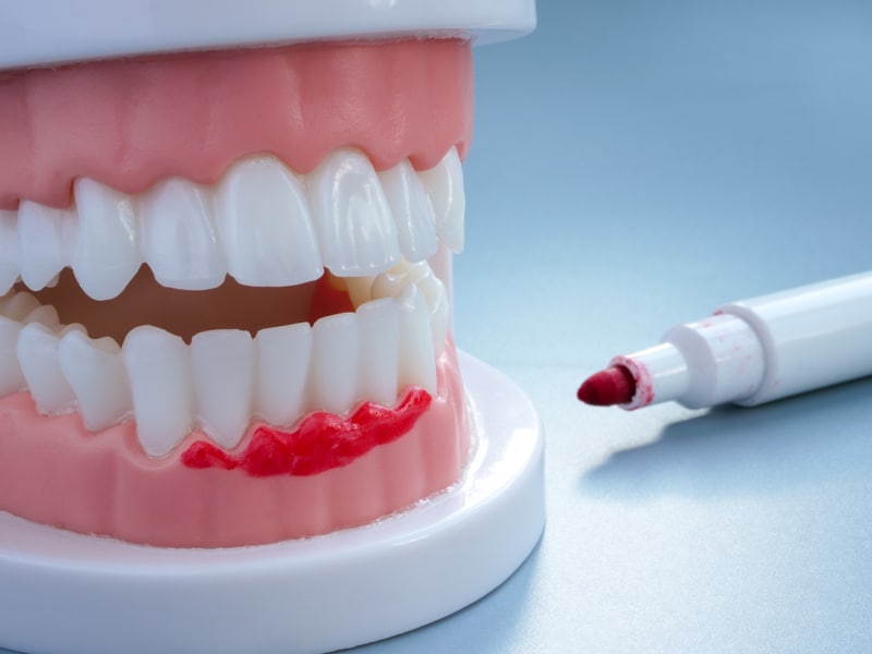 leczenie chorób dziąseł Kraków Implantis