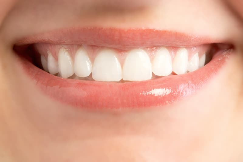 bonding stomatologia Kraków Implantis