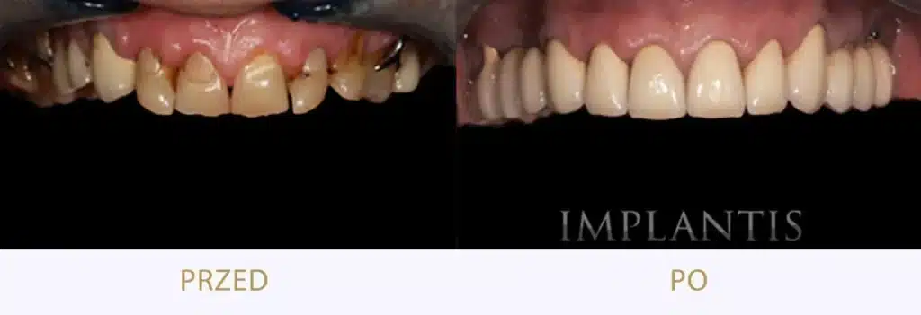 korony i mosty dentystyczne